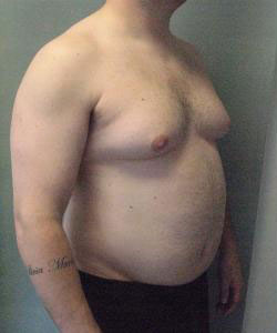 Severe Gynecomastia