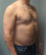 Severe Gynecomastia