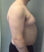 Severe Gynecomastia