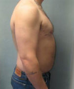 Severe Gynecomastia