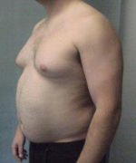 Severe Gynecomastia