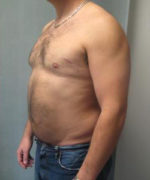 Severe Gynecomastia