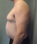 Severe Gynecomastia