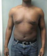 Severe Gynecomastia