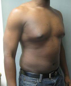 Severe Gynecomastia