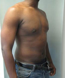 Severe Gynecomastia