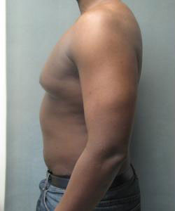 Severe Gynecomastia