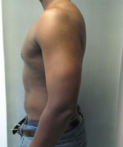 Severe Gynecomastia