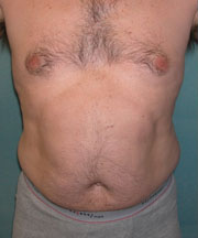 gynecomastia