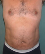 Combined Procedures After Photo Combined Procedures