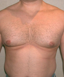 Combined Procedures Before Photo Combined Procedures