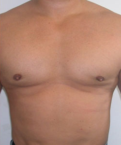 Combined Procedures After Photo Combined Procedures
