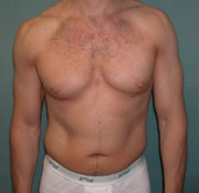Combined Procedures Before Photo Combined Procedures