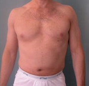 Combined Procedures After Photo Combined Procedures