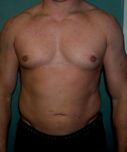 Combined Procedures Before Photo Combined Procedures