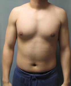 Combined Procedures Before Photo Combined Procedures