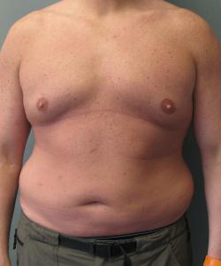 Combined Procedures Before Photo Combined Procedures