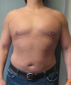 Combined Procedures After Photo Combined Procedures