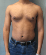 Severe Gynecomastia