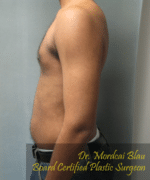 Severe Gynecomastia