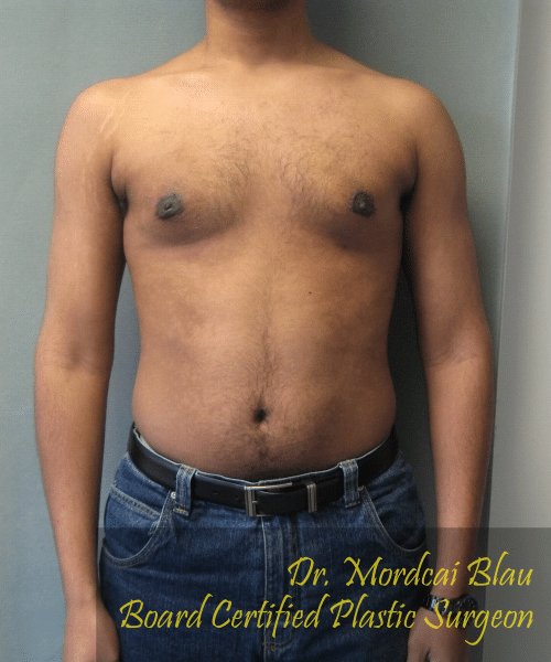 Severe Gynecomastia