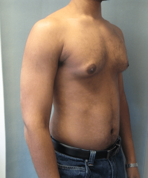 Severe Gynecomastia