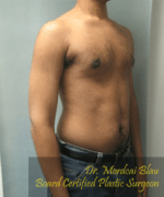 Severe Gynecomastia