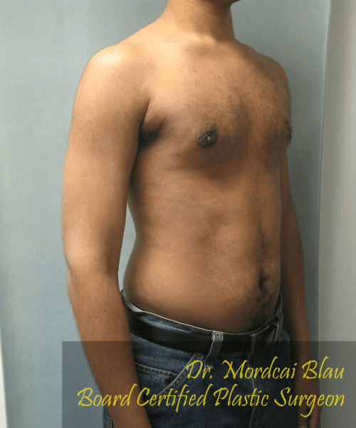 Severe Gynecomastia