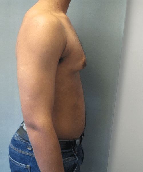 Severe Gynecomastia