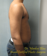 Severe Gynecomastia