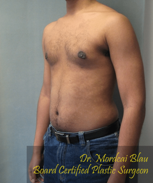 Severe Gynecomastia