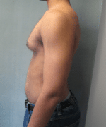 Severe Gynecomastia