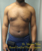 Severe Gynecomastia