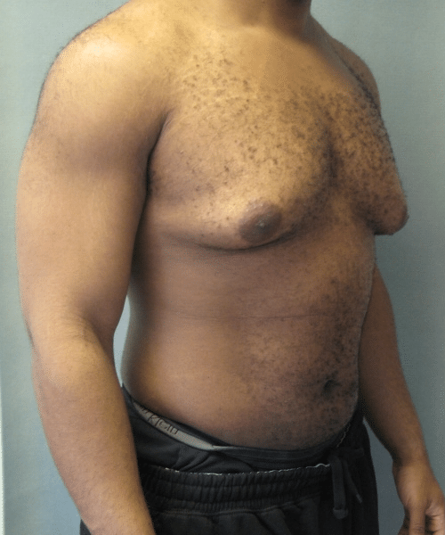 Severe Gynecomastia