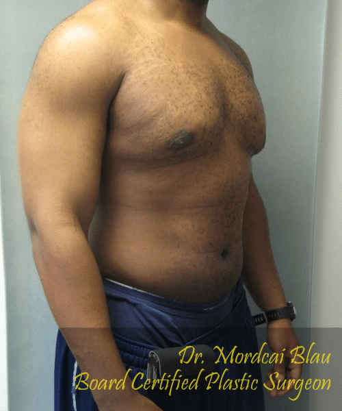 Severe Gynecomastia