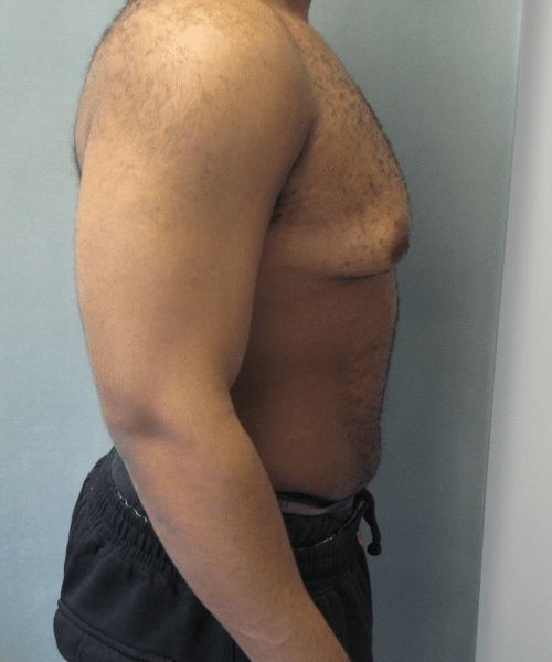 Severe Gynecomastia