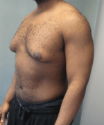 Severe Gynecomastia