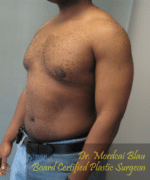 Severe Gynecomastia