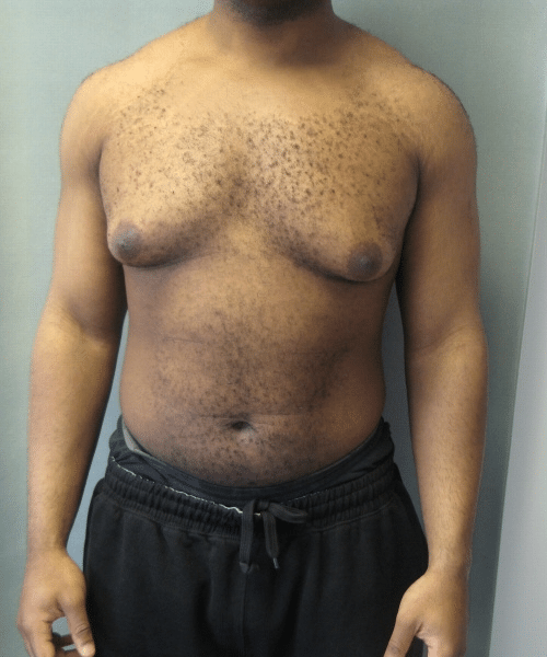 Severe Gynecomastia Before Photo Severe Gynecomastia