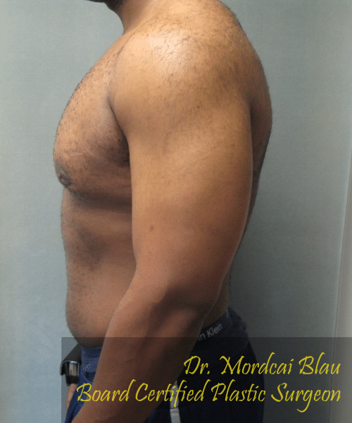 Severe Gynecomastia