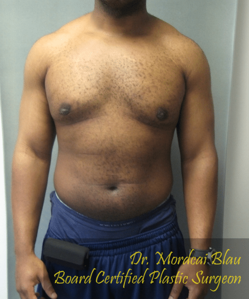 Severe Gynecomastia