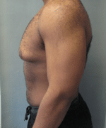 Severe Gynecomastia