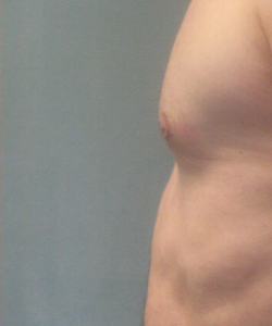 gynecomastia