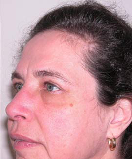 eyelid surgery