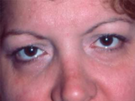 Eyelid surgery (Blepharoplasty)