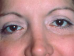 Eyelid surgery (Blepharoplasty)