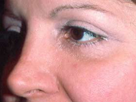 Eyelid surgery (Blepharoplasty)