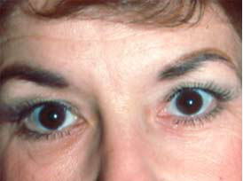 Eyelid surgery (Blepharoplasty)