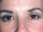 Eyelid surgery (Blepharoplasty)