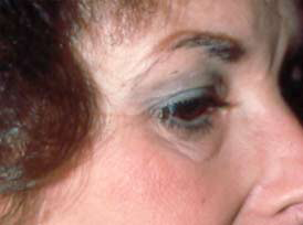 Eyelid surgery (Blepharoplasty)